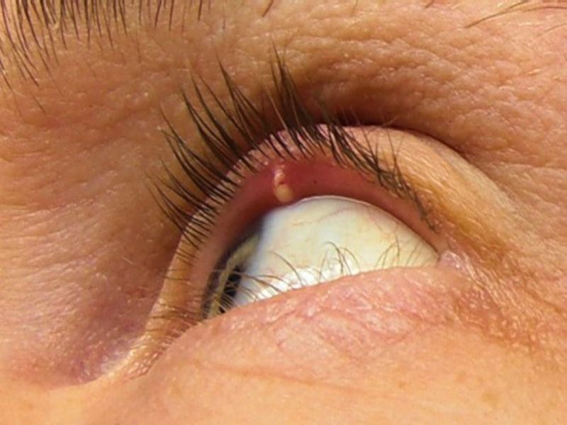 Стадии болезни