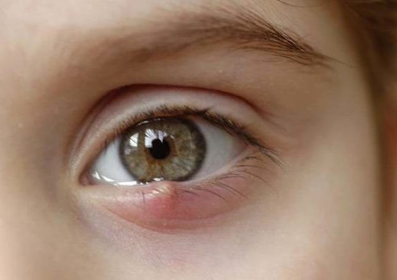 Как долго лечится ячмень