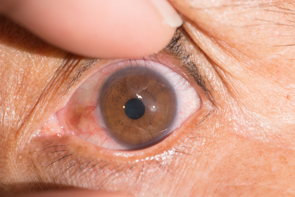 Эрозия роговицы глаза