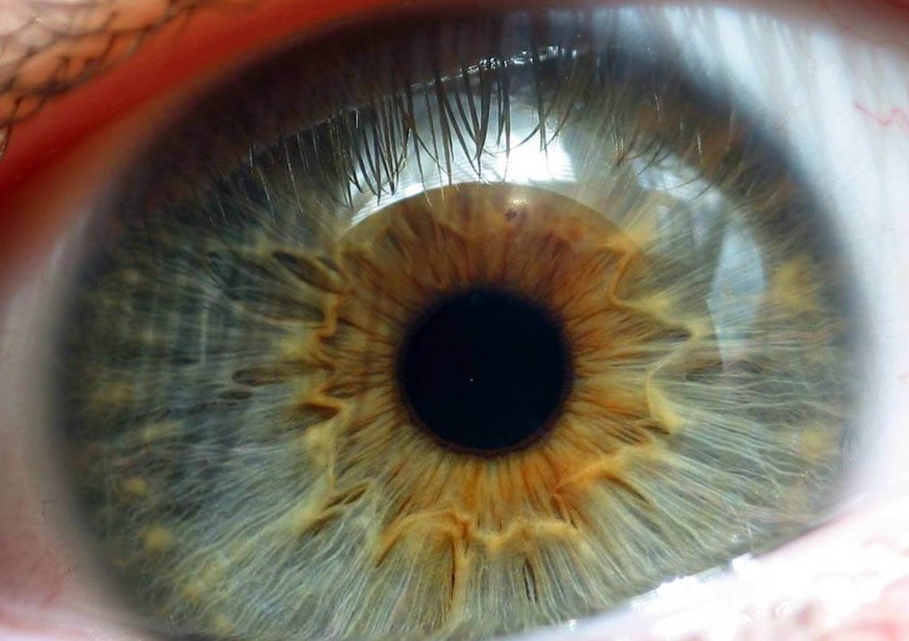 Истончение сетчатки глаза