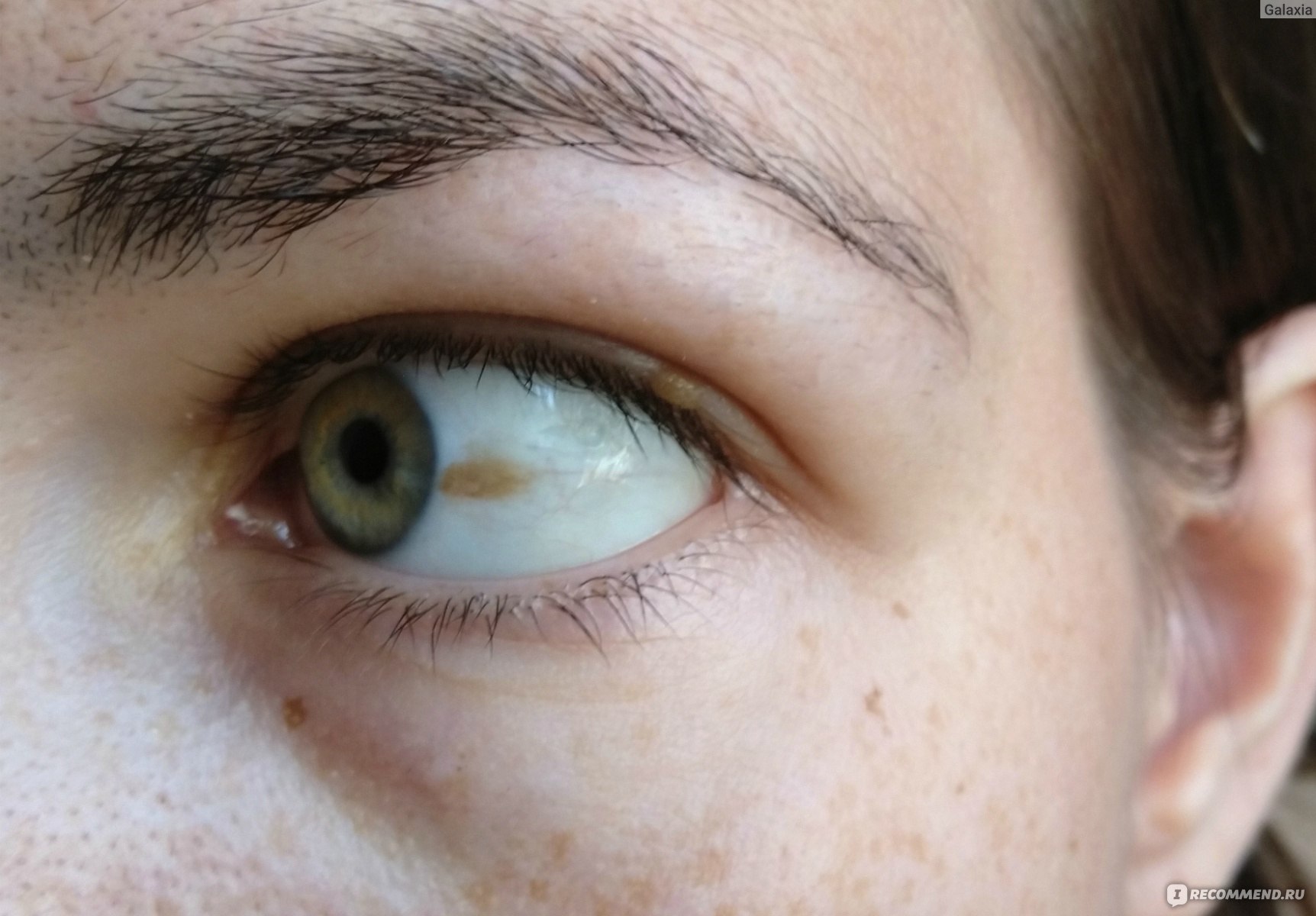 желтая пленка на глазу