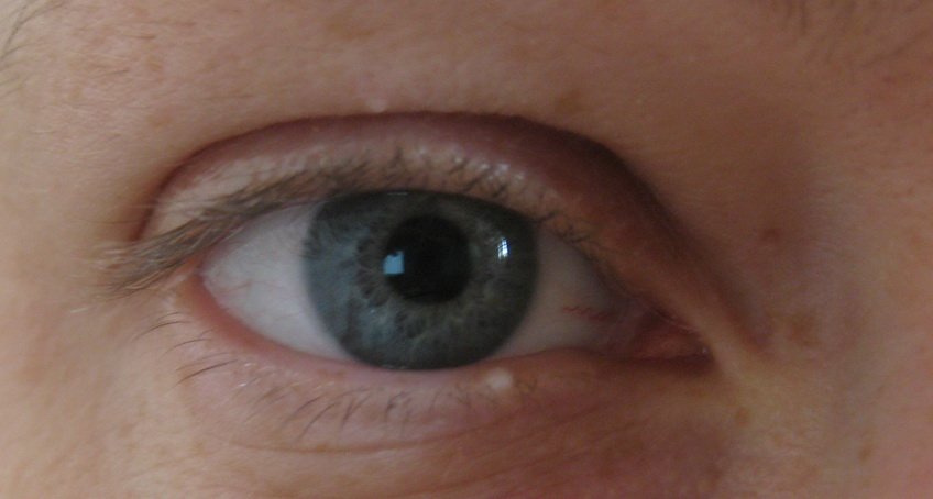 Атерома (новообразование) на веке глаза